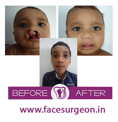 cleft lip and palate before and after sugery