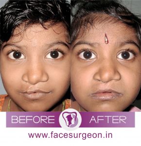 Cleft Lip Revision Surgery in India