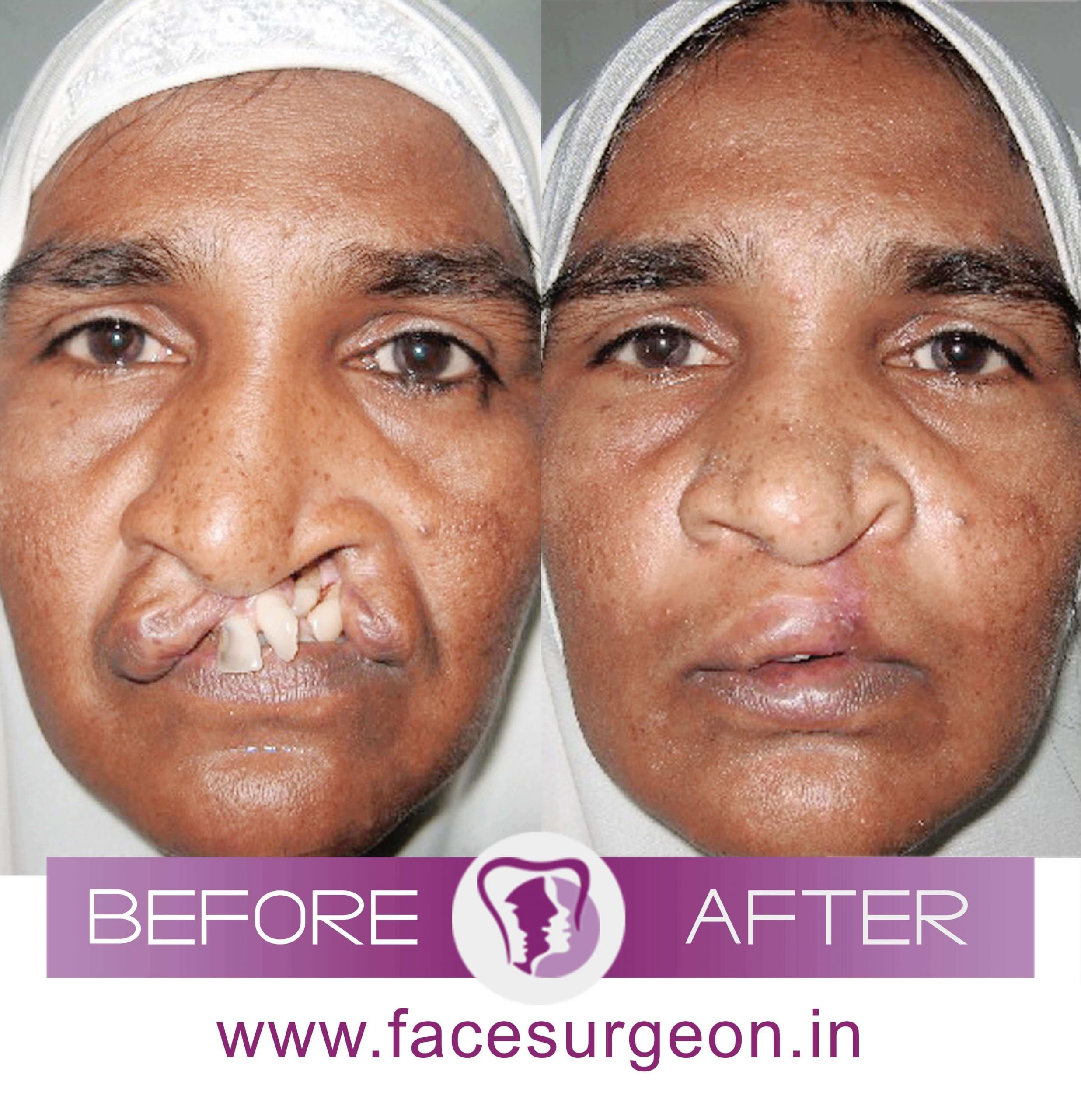 Cleft Lip Surgery in India
