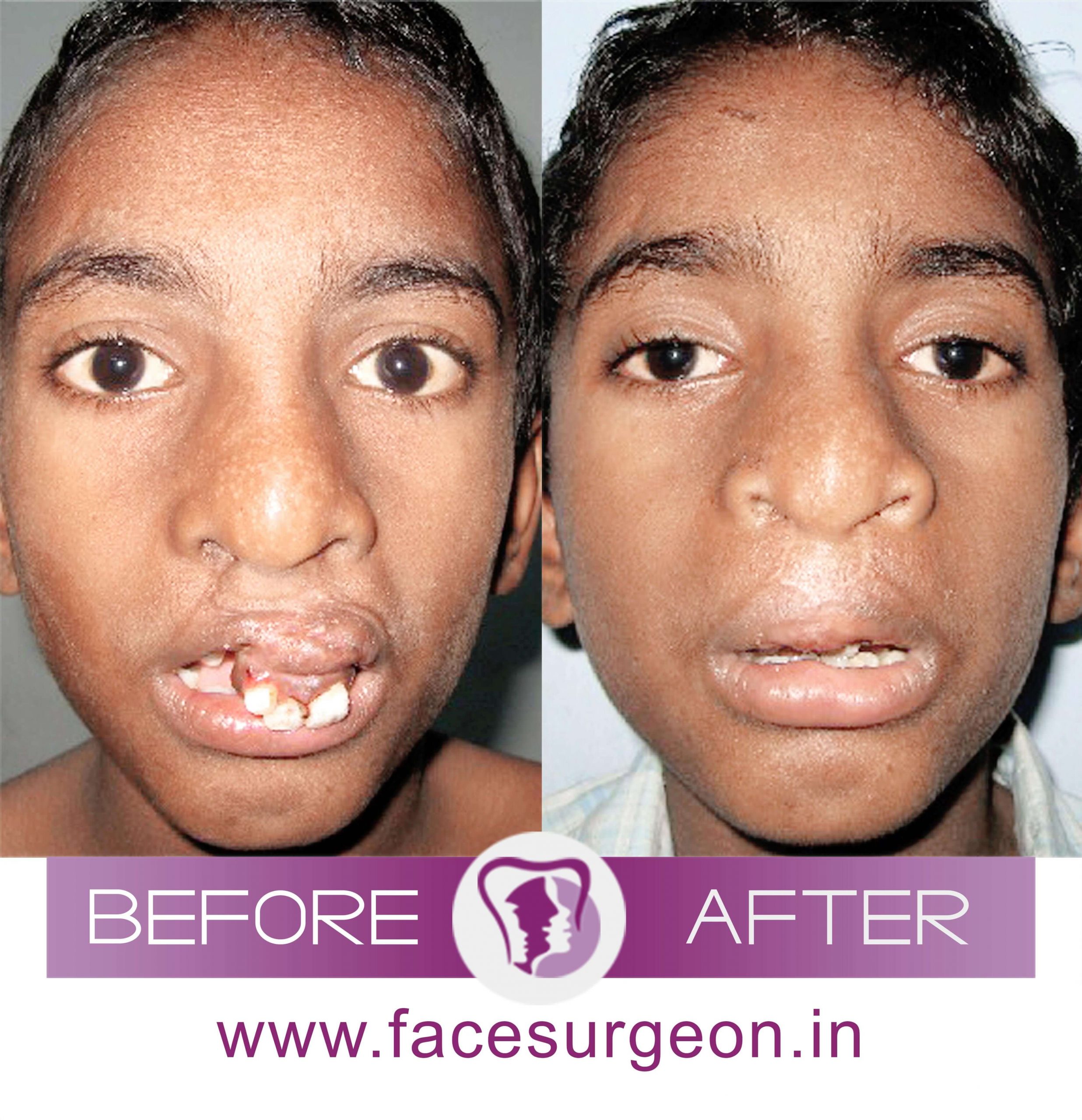 Cleft Palate Revision Surgery