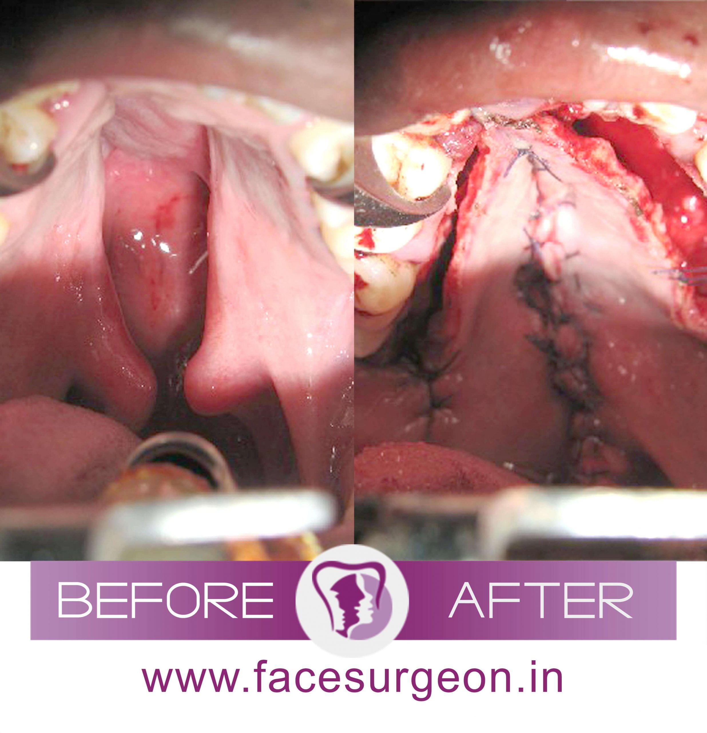 Cleft Palate Surgery