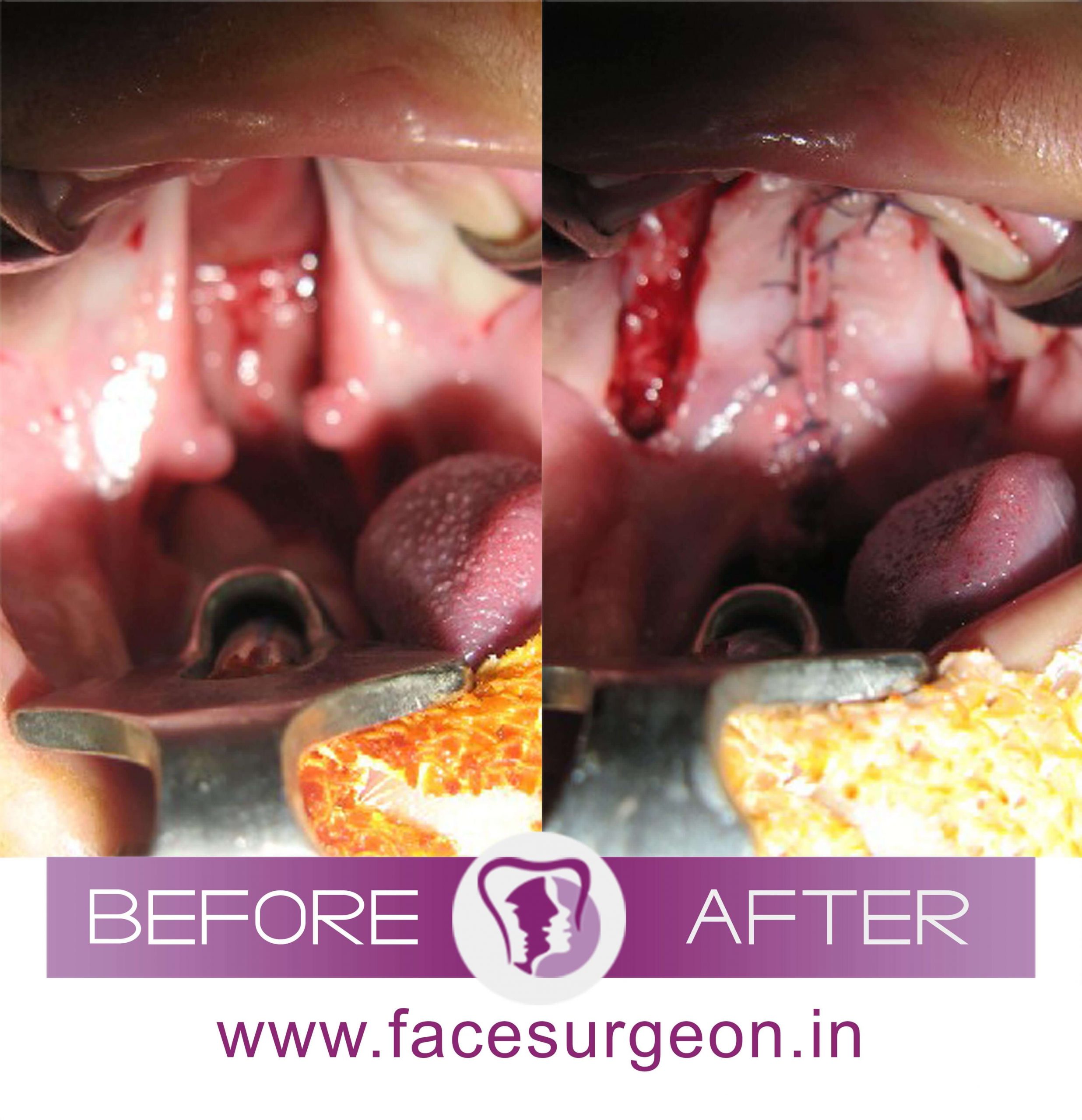 Cleft Palate Surgery in India