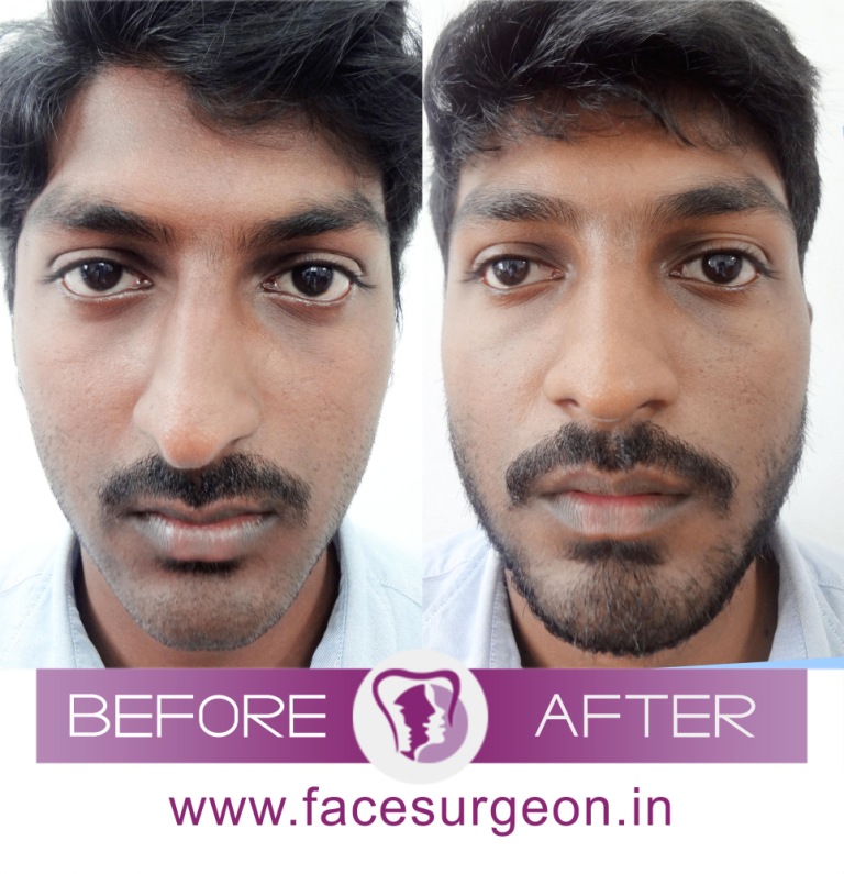 Cosmetic Nose Surgery in India