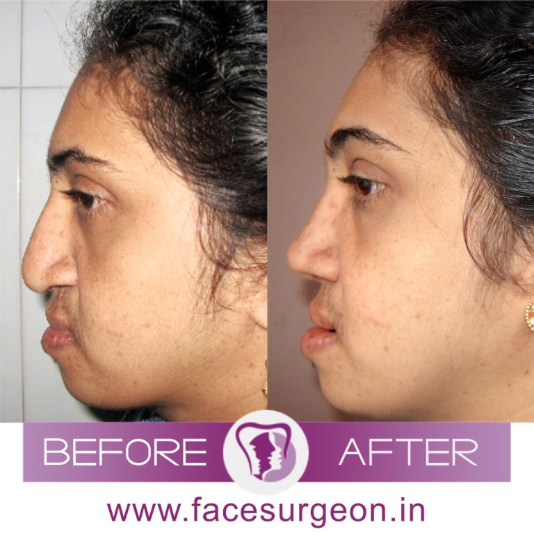 Nose Reshaping Surgery in India
