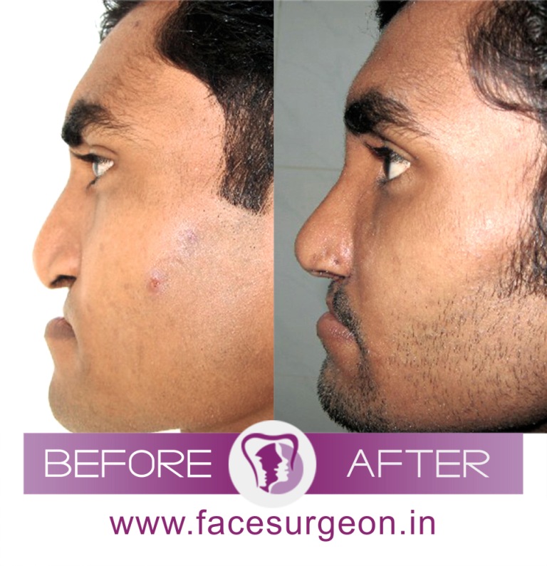Orthognathic Surgery in India