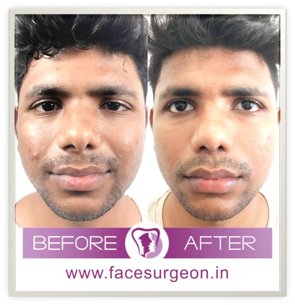 front view of rhinoplasty surgery