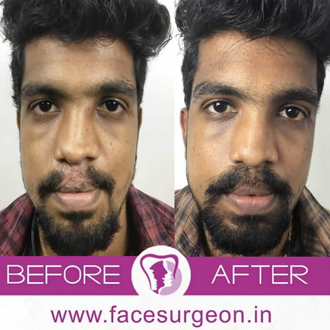 Moustache Transplant Surgery in India