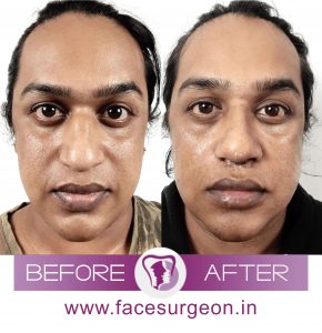 Adult Nose Correction Surgery