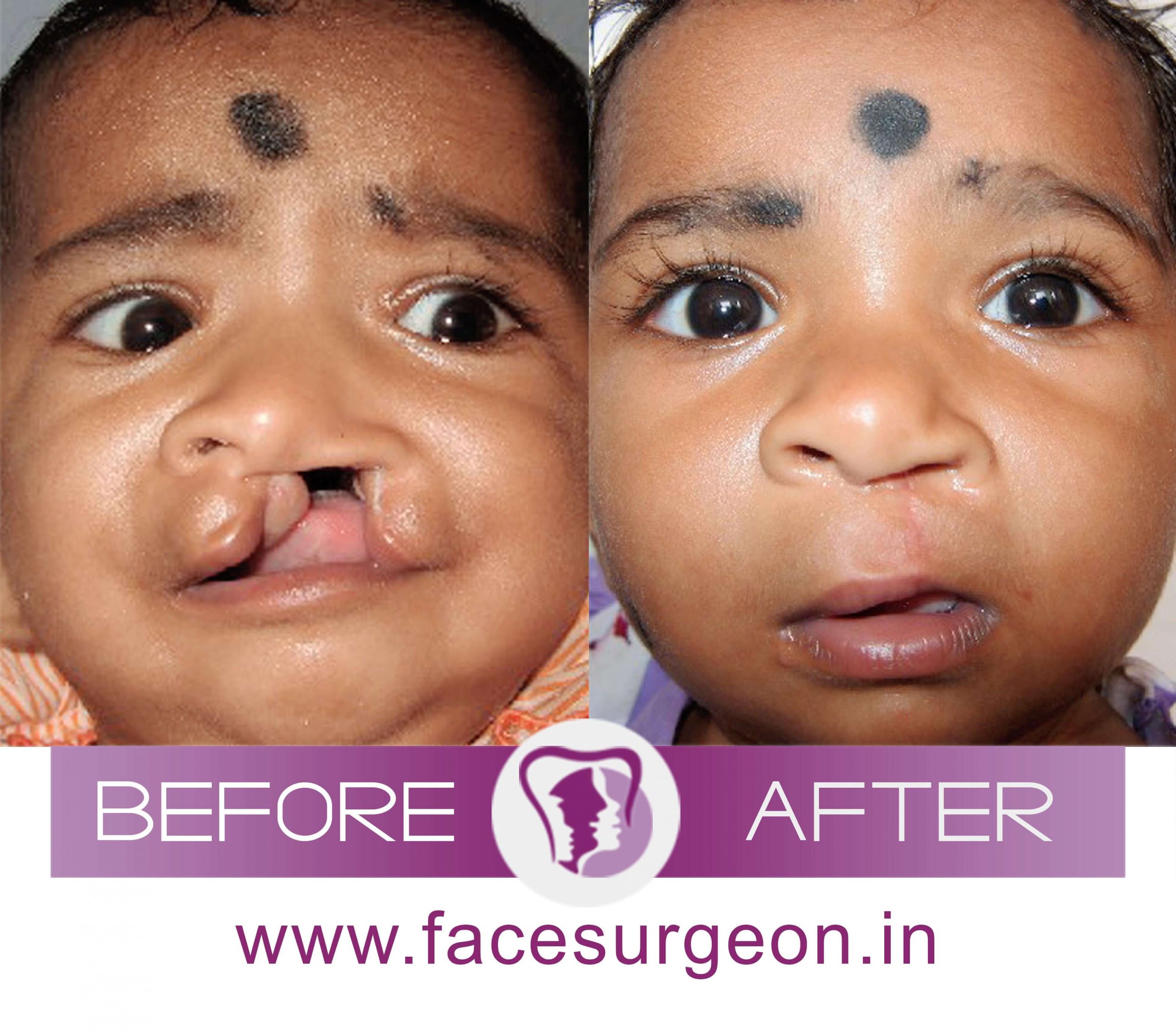 Baby Cleft Palate Surgery Result