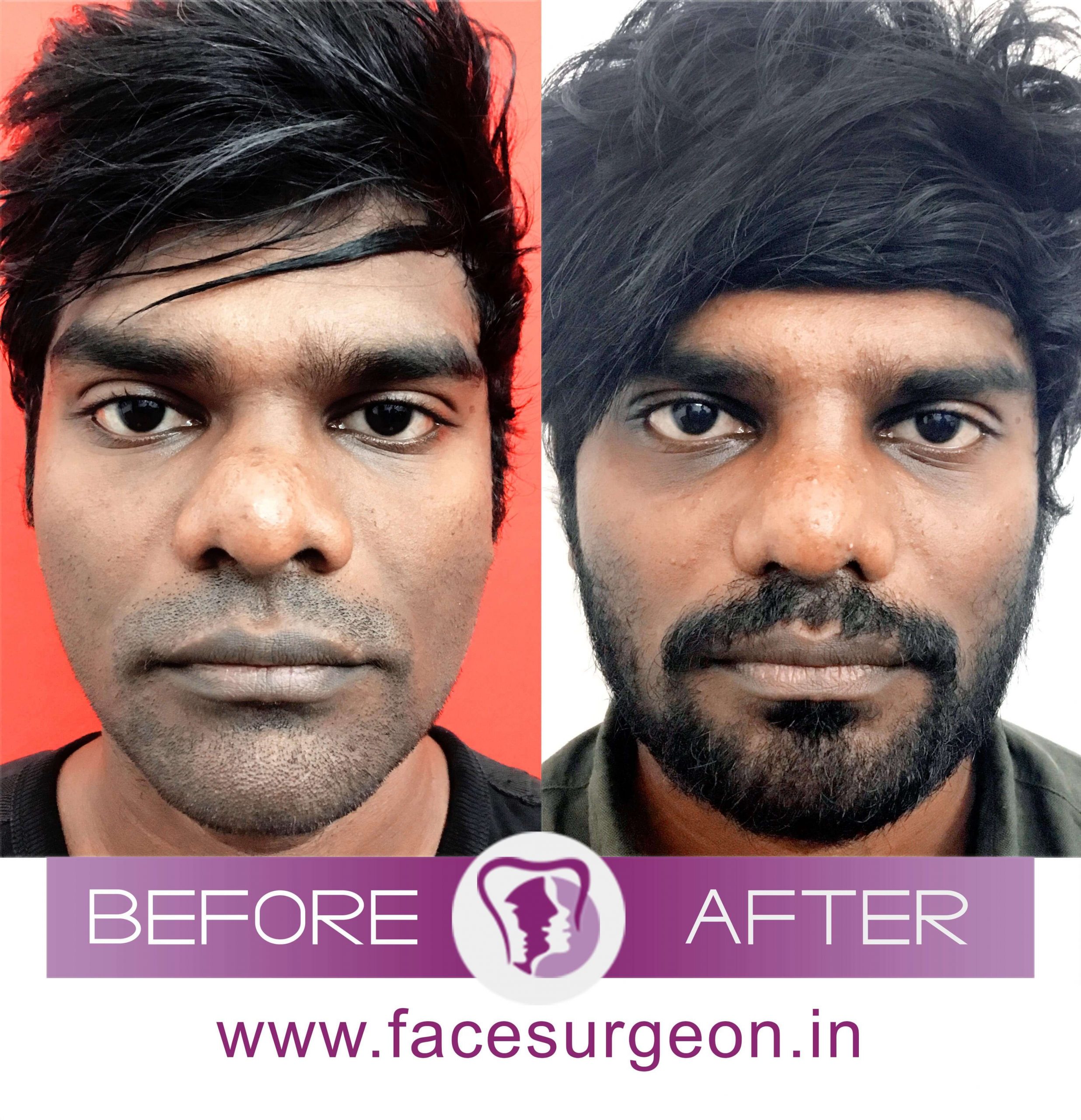 Nose Correction Surgery