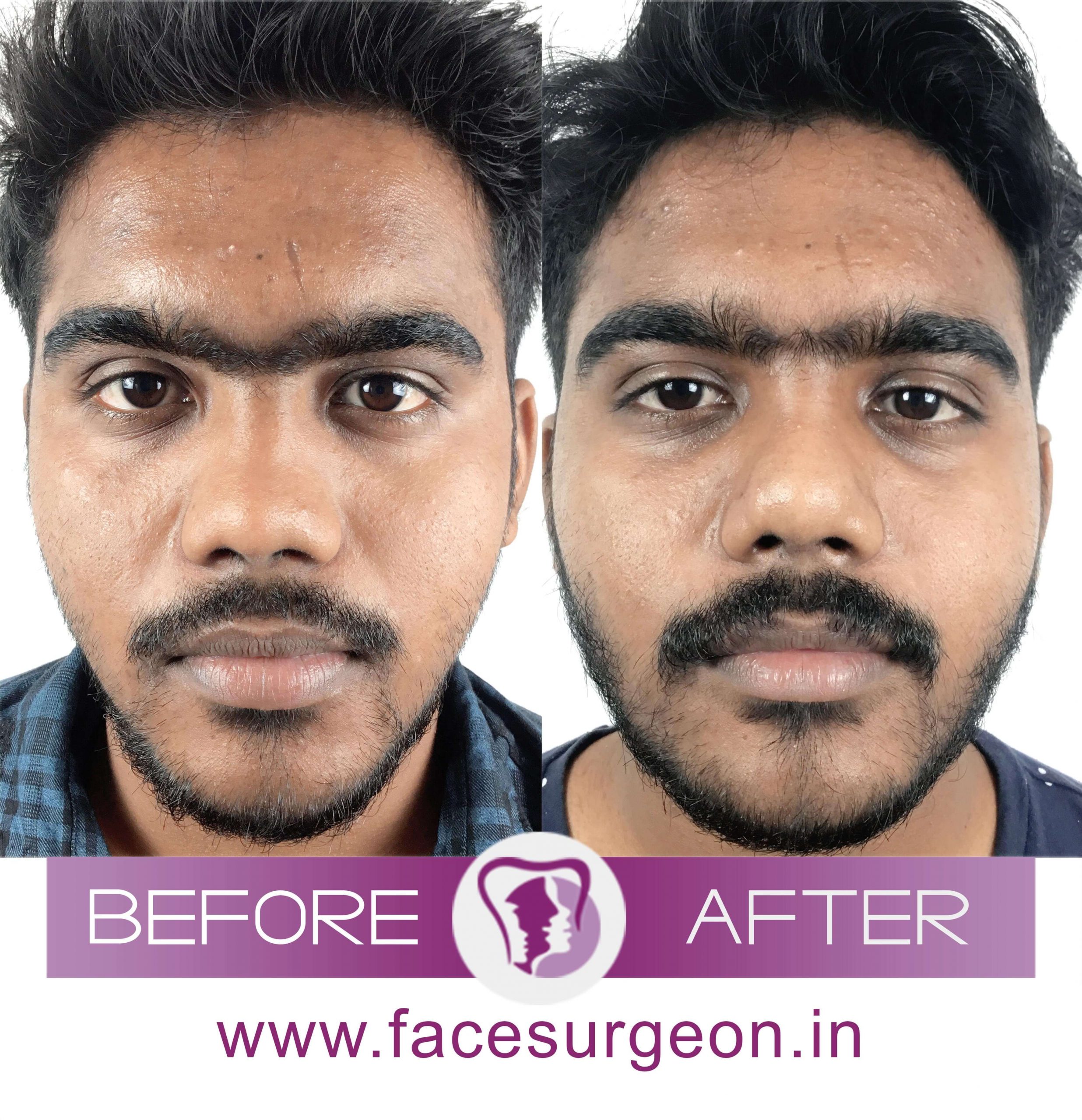 Nose Corrective Surgery