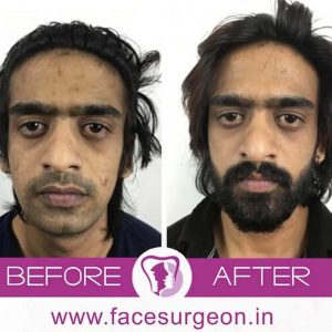 Beard and receded chin surgery