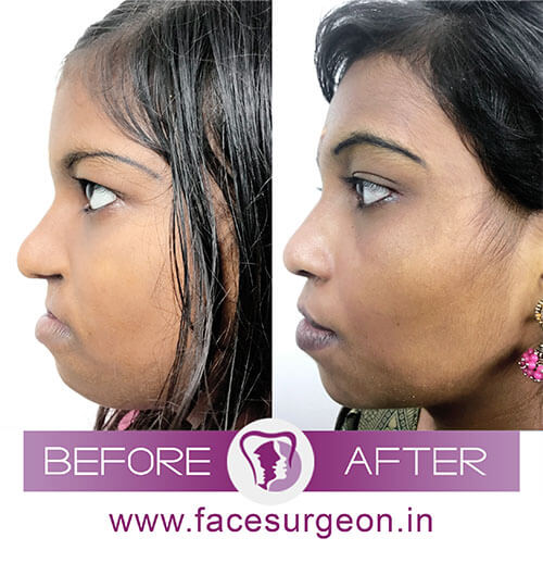 Cleft Lip Repair Technique in India
