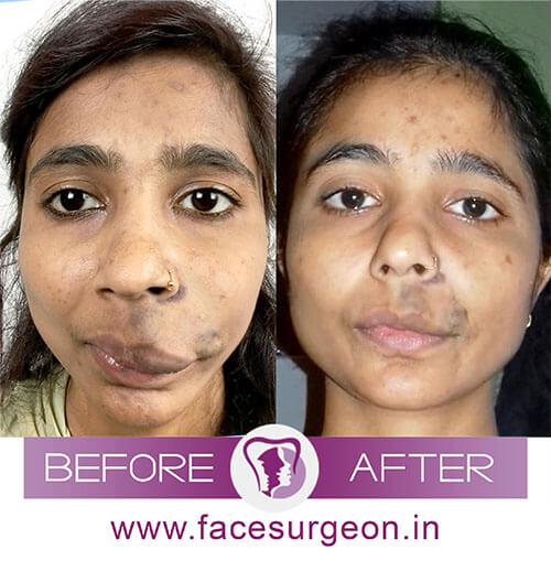 Face Hemangioma Plastic Surgery India