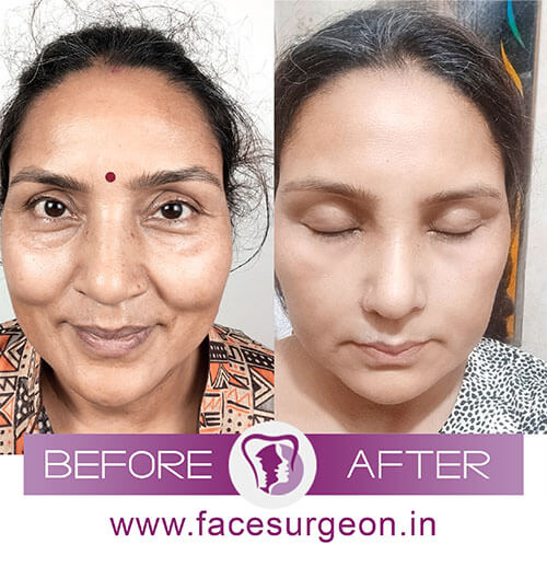 Facial Plastic Surgery India