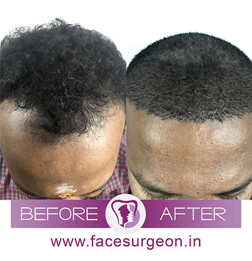 Hair Transplant Procedure India