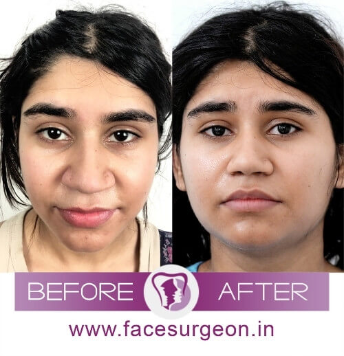 Nose Size Reduction Surgery India