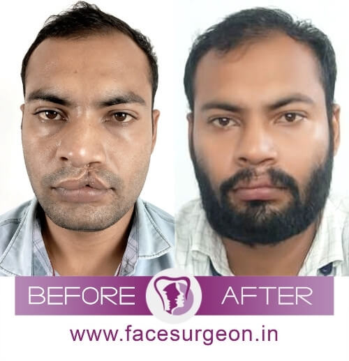 Rhinoplasty Nose Reshaping Surgery India