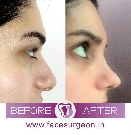 Rhinoplasty for Sharp Nose in India