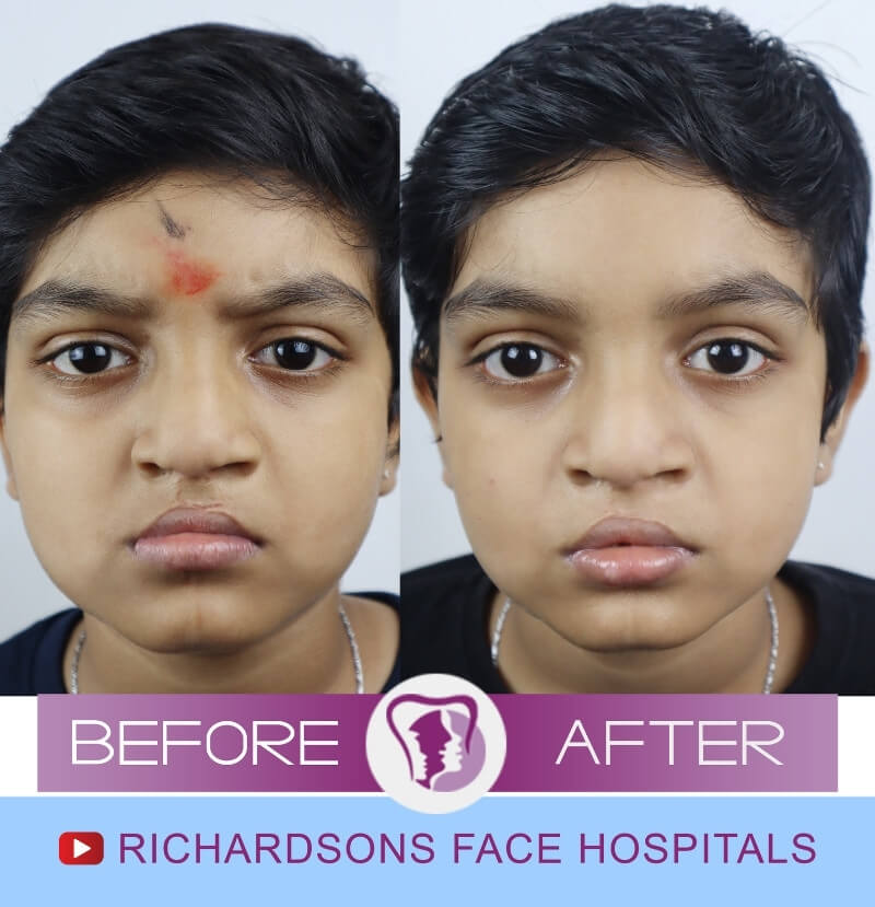 Abishck Nose Surgery India