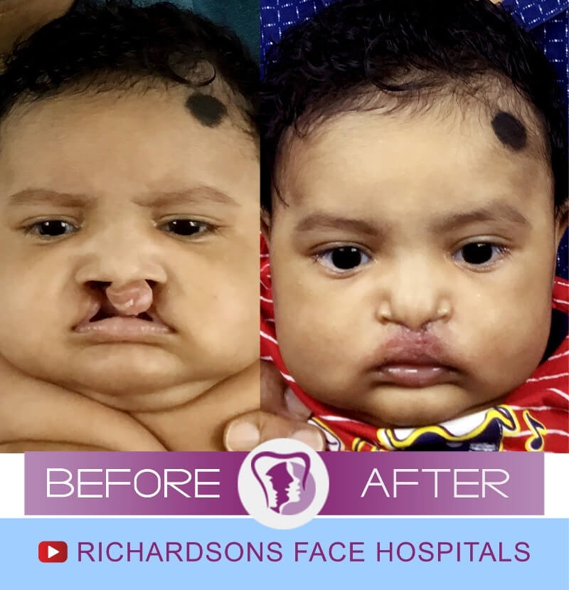 Sathvikka Cleft Lip Palate Surgery