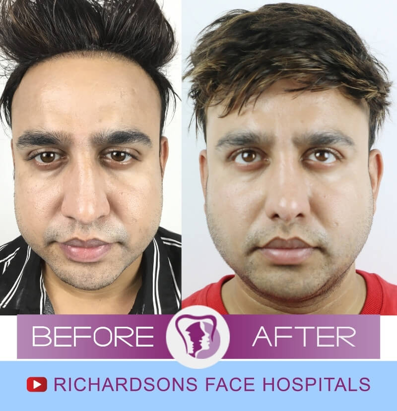 Akshit Sharma Nose Surgery