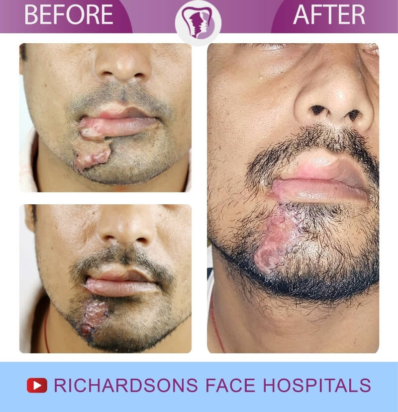Anil Scar Removal Surgery