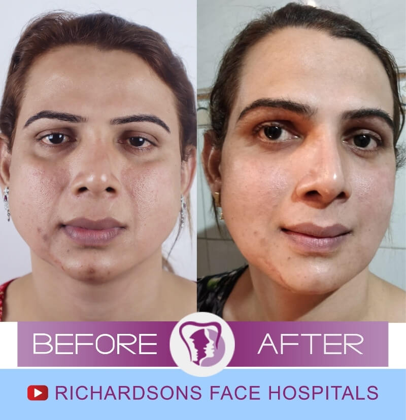 Anitha Giri Nose Surgery