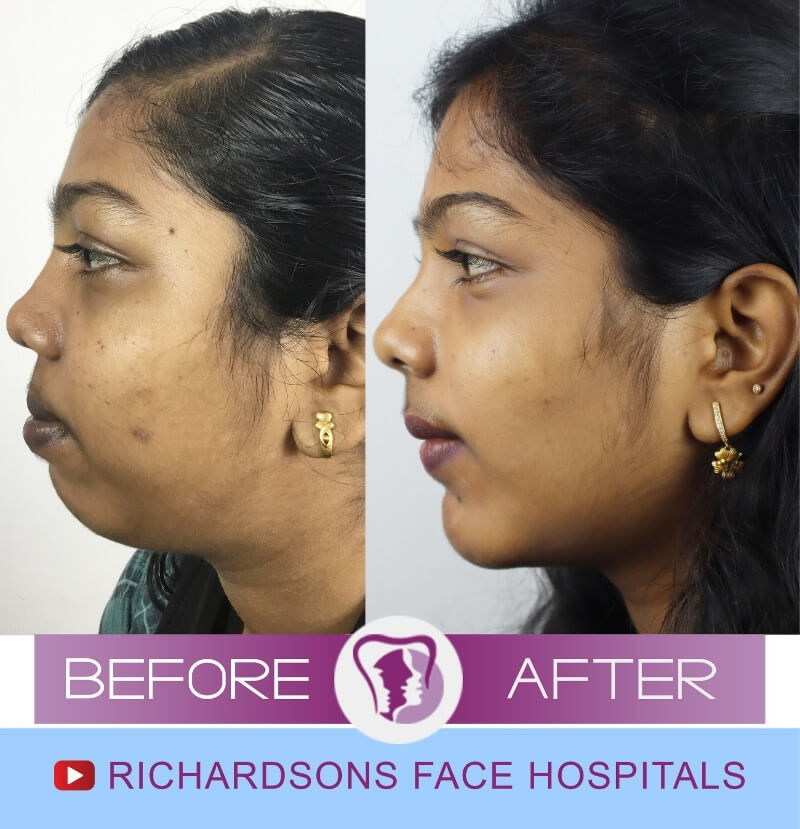Ashmi Nose Surgery Side View