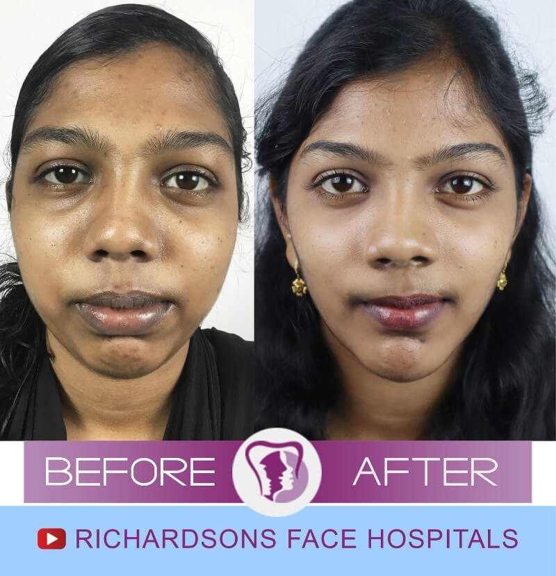 Ashmi Nose Surgery