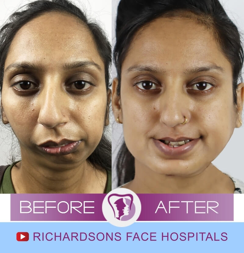 Facial Asymmetry Surgery Prita