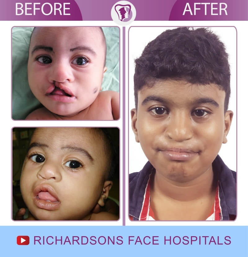 Hashir Cleft Lip Palate Surgery