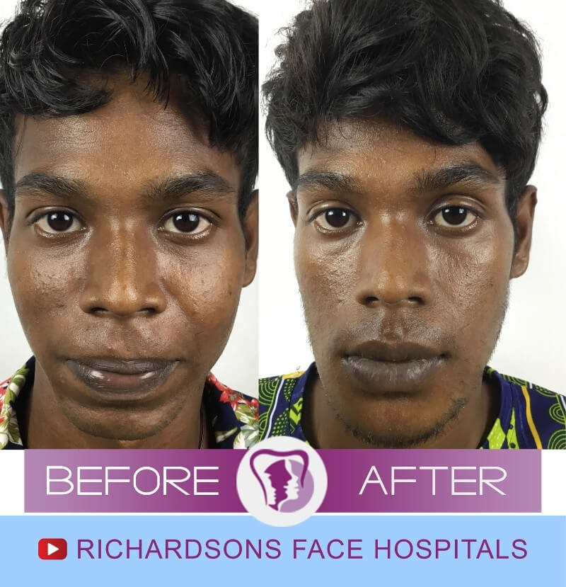 Kalimuthu Facial Trauma Surgery