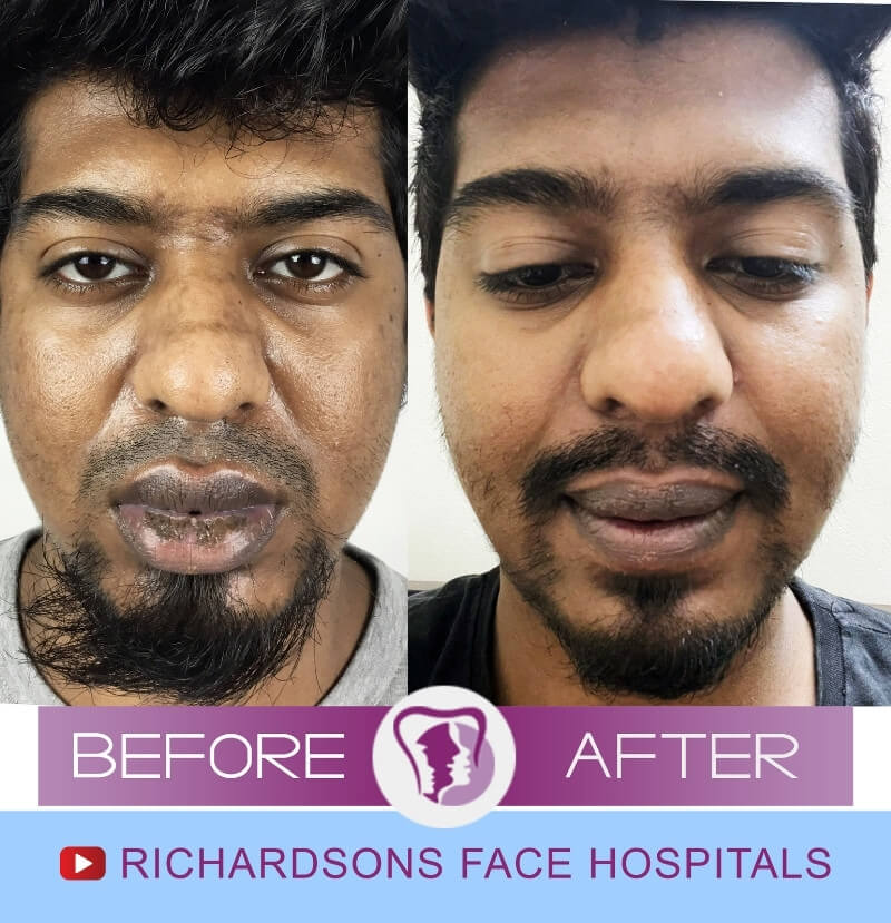 Karthik Lip Reduction Surgery
