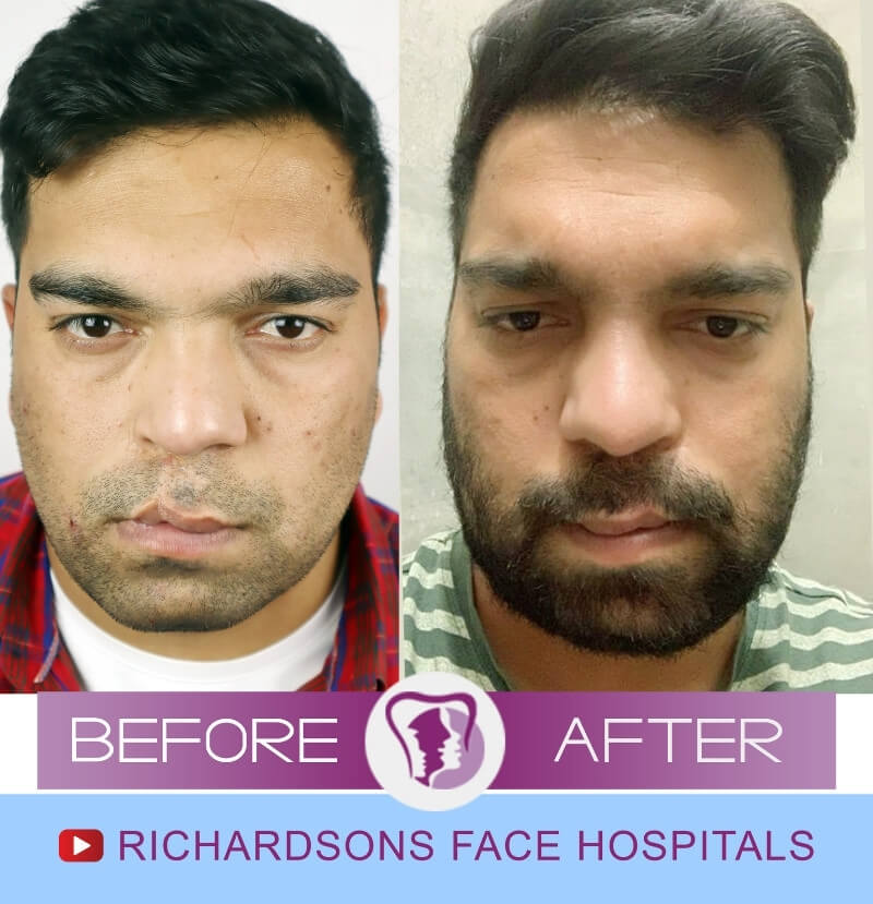 Lip Reduction Surgery Gagandeep