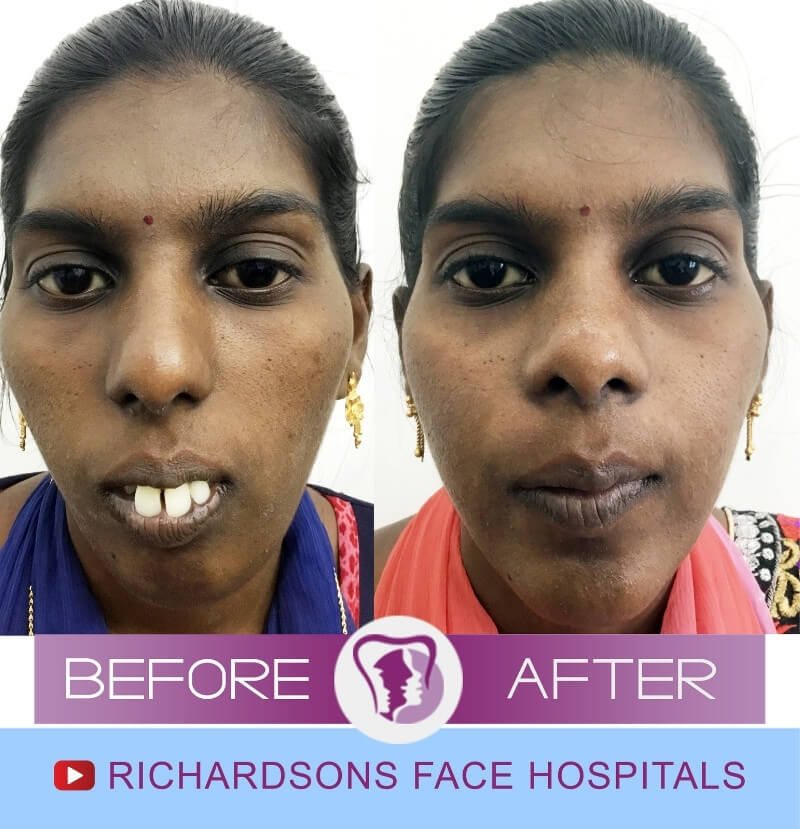 Mariakanaga Nose Surgery
