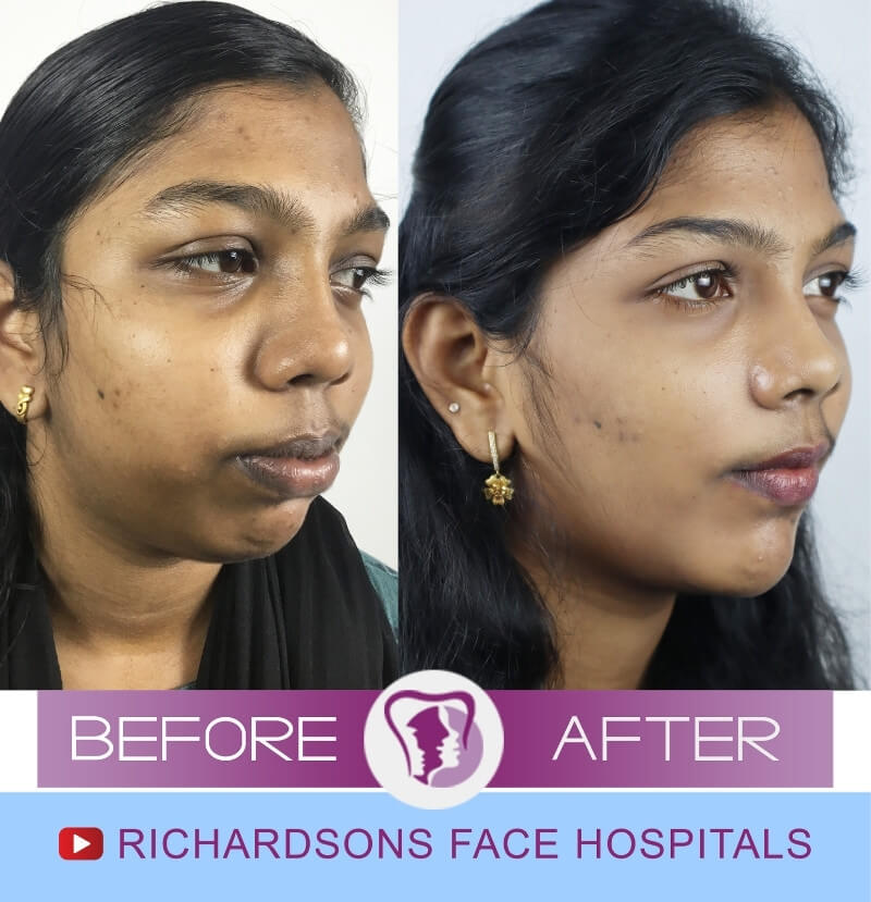 Nose Surgery Side View Ashmi