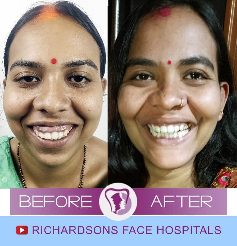 Puja Jaw Surgery in India