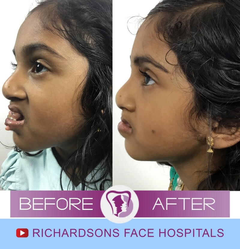 Rahma Jaw Surgery Side View