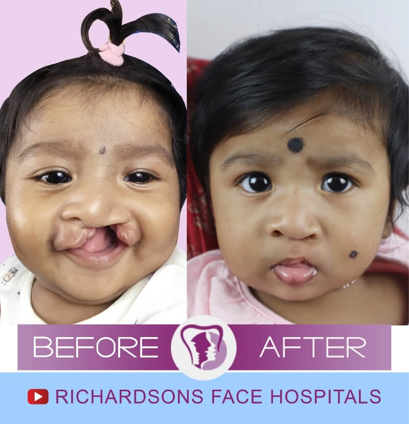 Sathvikka Cleft Lip Palate Surgery