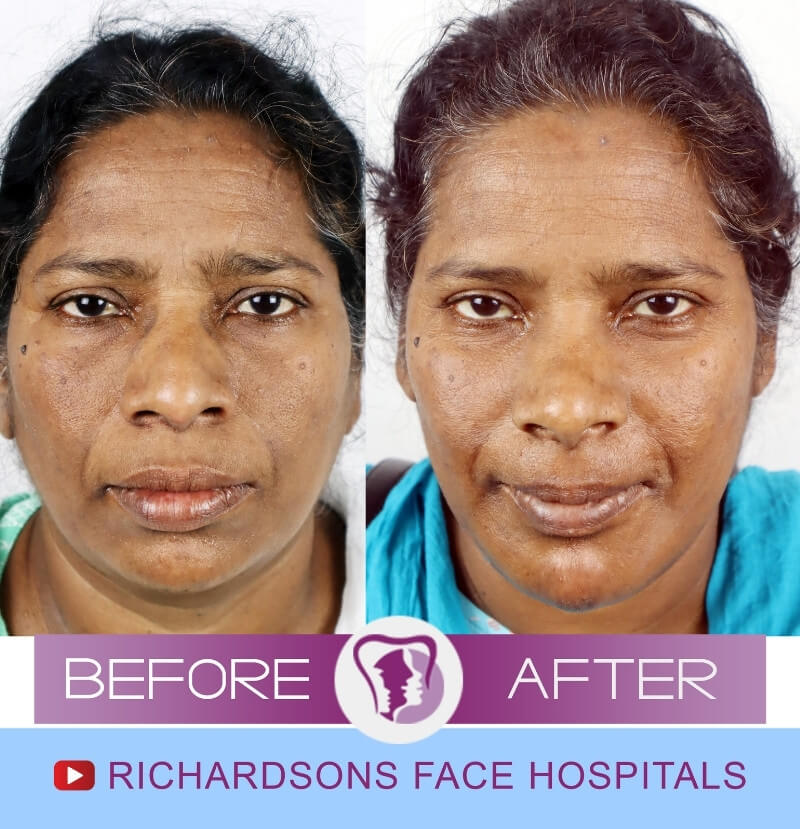 Satya Latha Nose Surgery