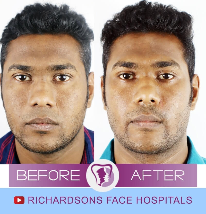 Stanley Scar Removal Surgery