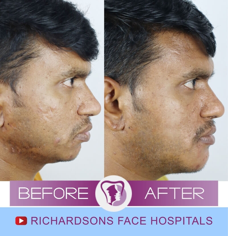 Suneel Scar Removal Surgery