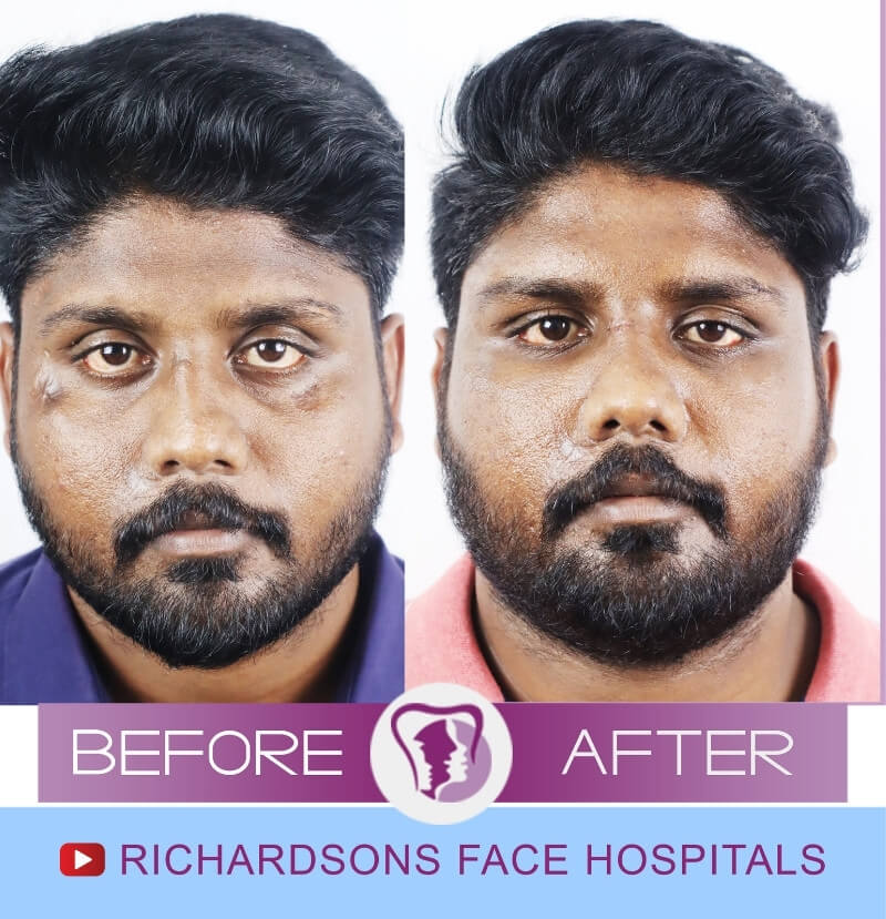 Suresh Scar Removal Surgery