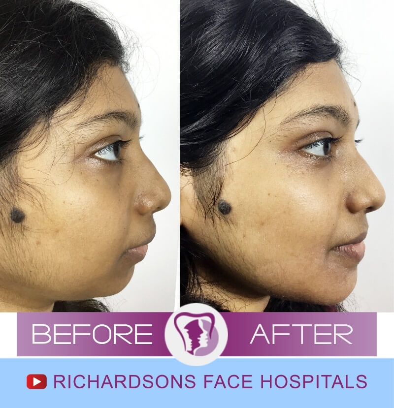 Teja Nose Surgery Side View