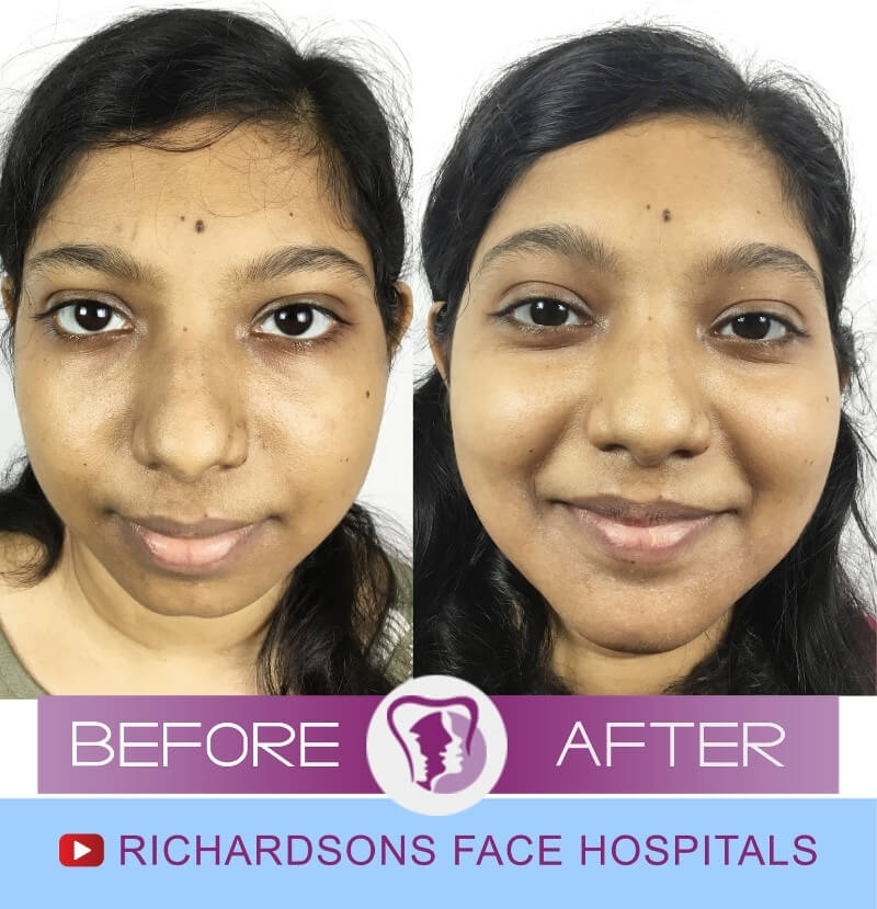 Teja Nose Surgery in India