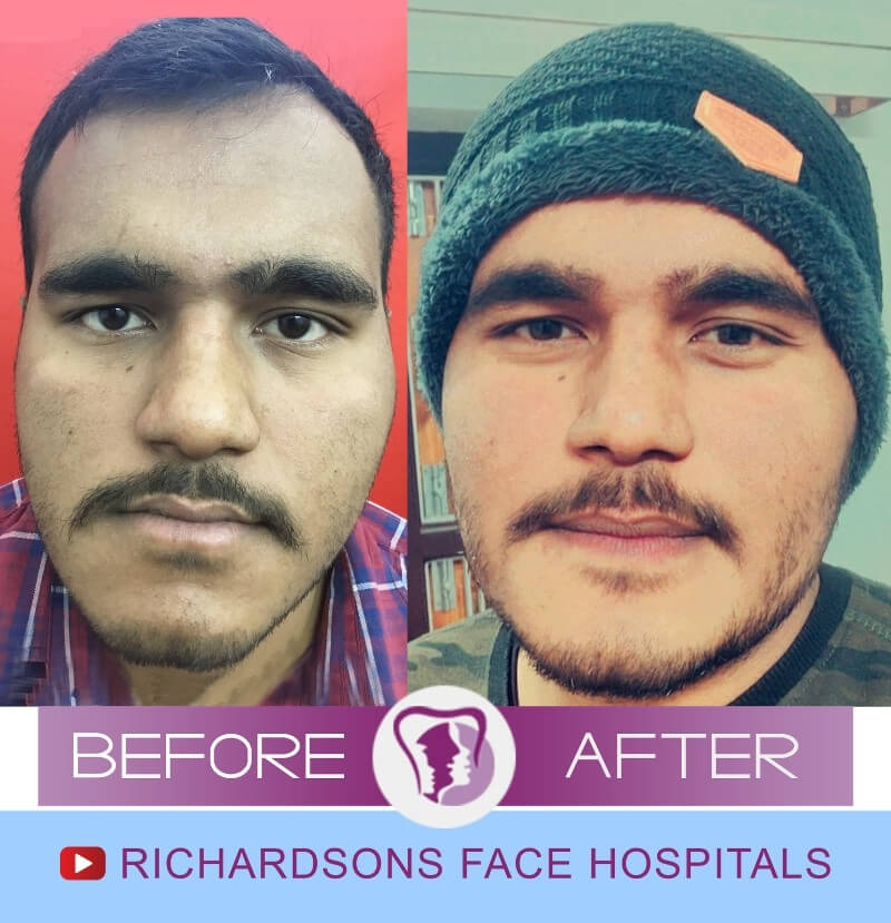 Vishal Face Makeover Surgery