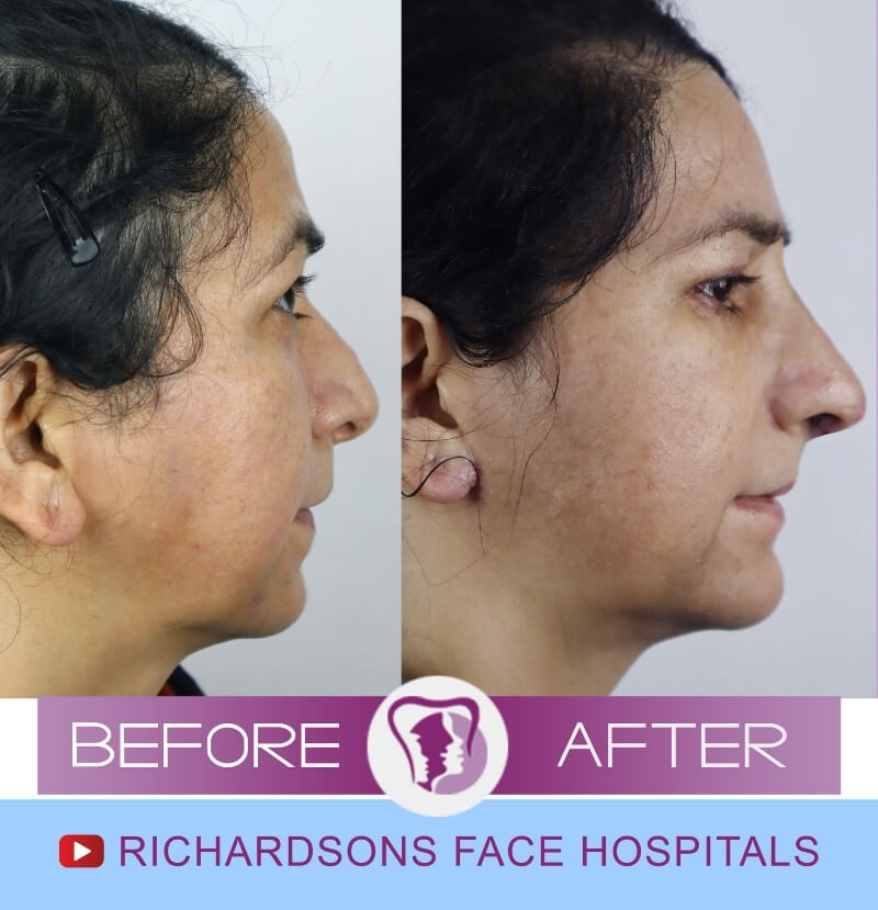 Aafia Face Makeover Side View