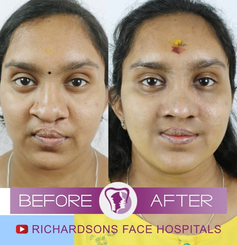 Aiswarya Cleft Lip Palate Surgery
