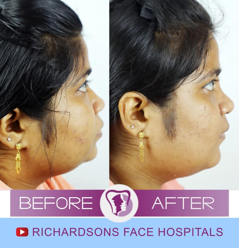 Facial Asymmetry Surgery Haleema